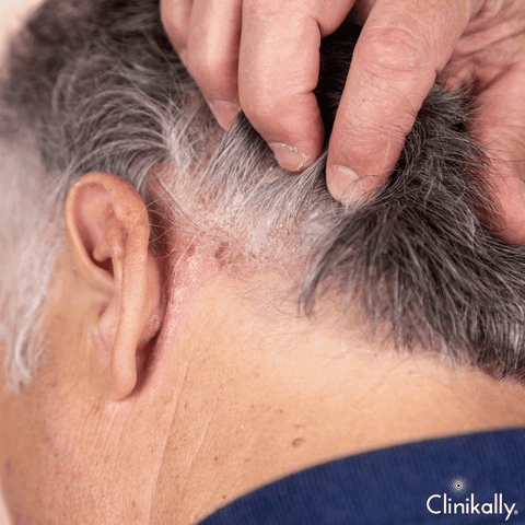 Procapil hair serum: Side effects