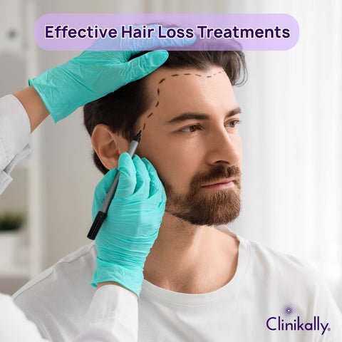 Effective Hair Loss Treatments