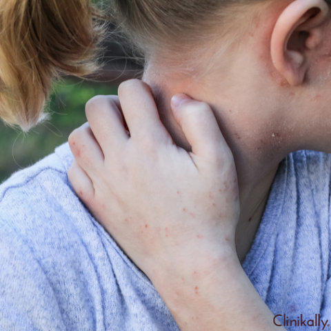 Laundry detergent breakouts
