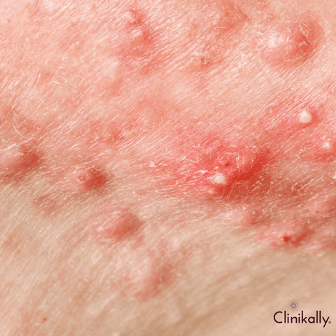 Hormonal influences on acne development