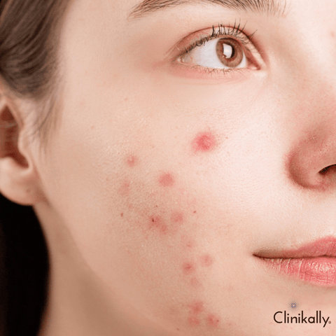 9 Ingredients to avoid for acne-prone skin