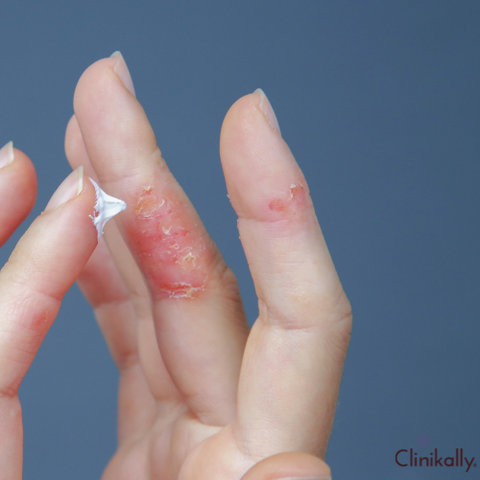 urea benefits skin