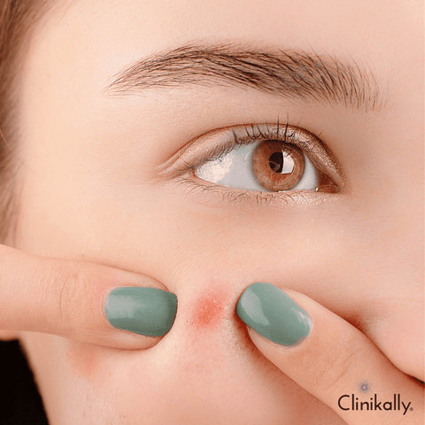 What causes pimples?