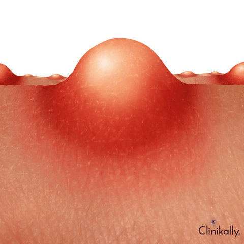 Types of acne: Symptoms of different acne types