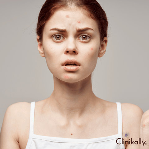 Benzoyl peroxide for acne