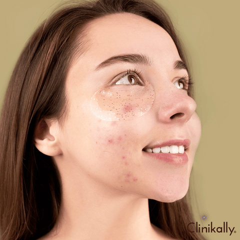 Benzoyl peroxide for acne scars