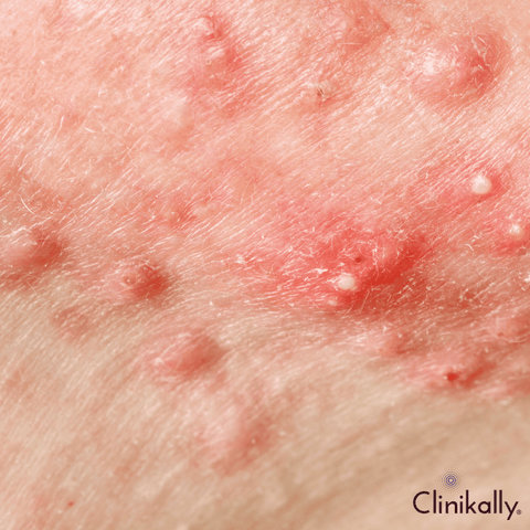 Benzoyl peroxide for cystic acne