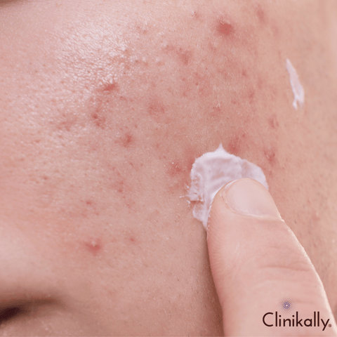 Types of Benzoyl peroxide acne treatment products