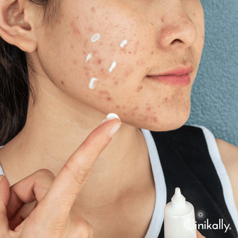 Acne cream & lotions