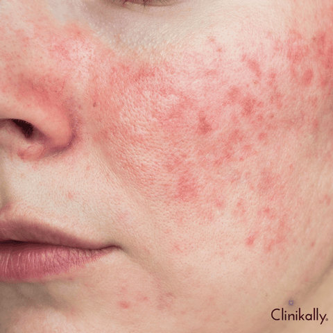 Potential risks and side effects of Kojic Acid