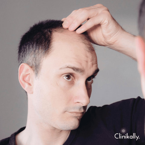 Causes of Male Pattern Baldness