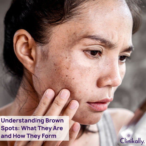 Understanding Brown Spots: What They Are and How They Form