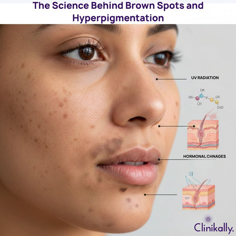 The Science Behind Brown Spots and Hyperpigmentation