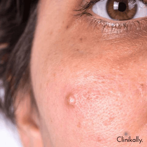 Papules