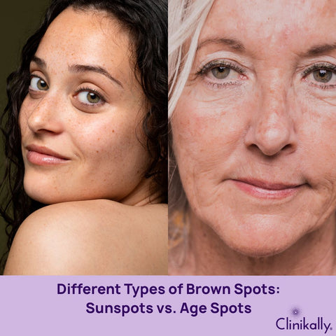 Different Types of Brown Spots: Sunspots vs. Age Spots