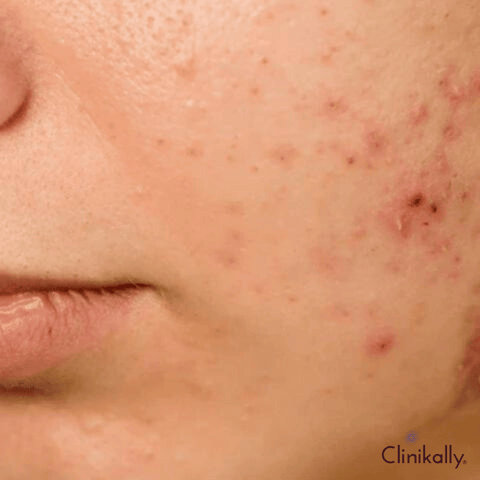 What causes acne?
