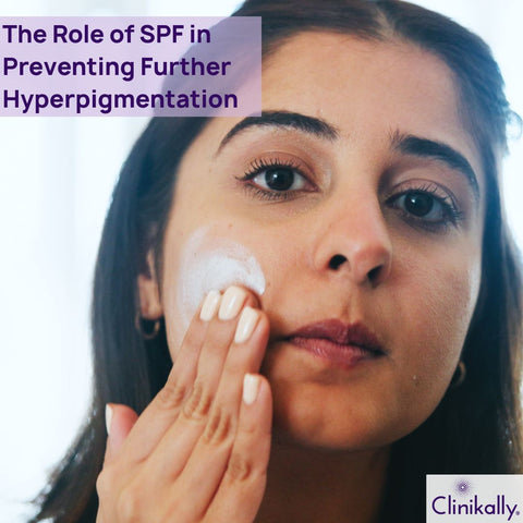The Role of SPF in Preventing Further Hyperpigmentation