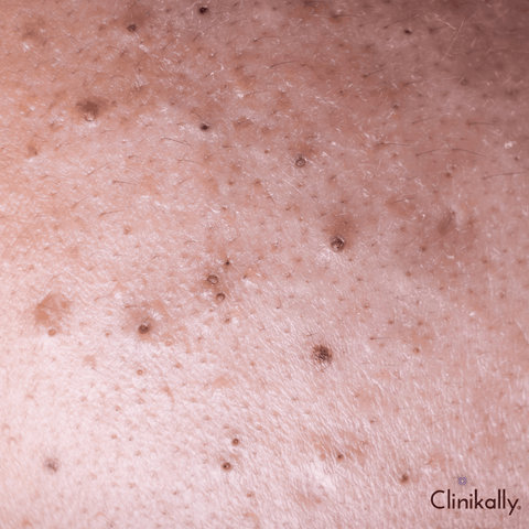 Understanding the role of sebum in clogged pores