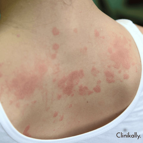 Atopic dermatitis