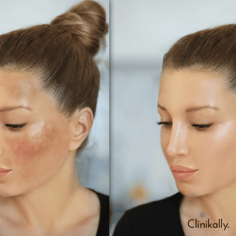 What are the causes of dark spots?