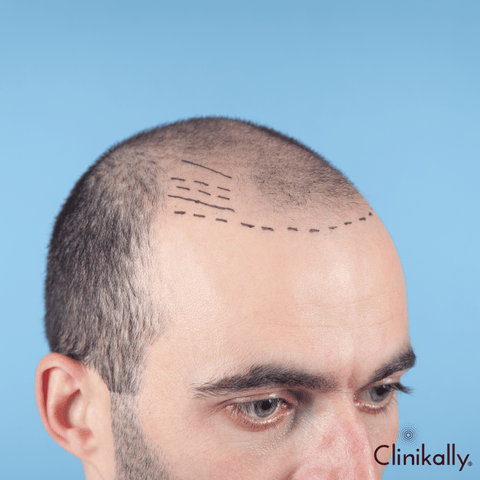 Hair transplant: Is it right for you?