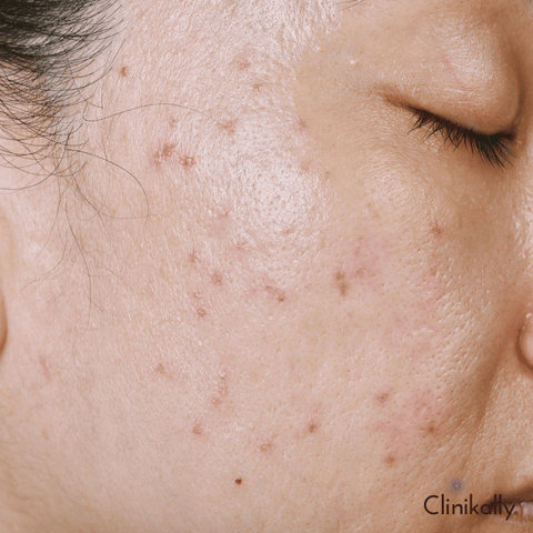 Post-Acne Care and Scar Treatment