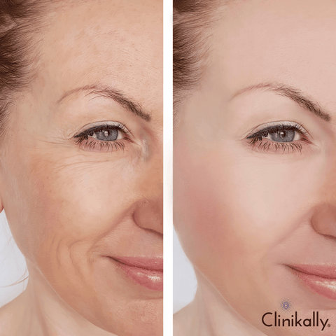 The Connection Between Skin Elasticity and Wrinkles