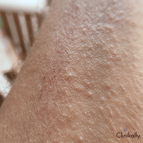 Contact dermatitis