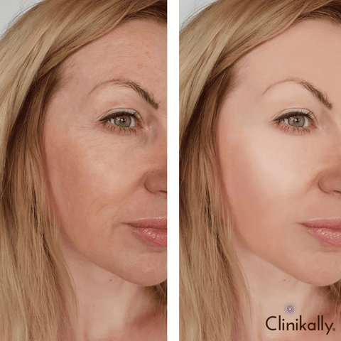 Hyaluronic Acid Serum Before and After