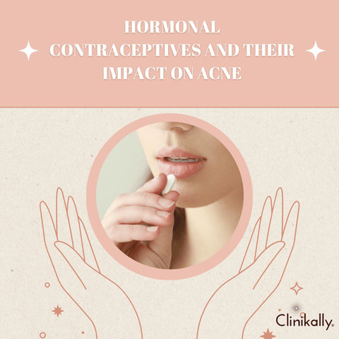 Hormonal contraceptives and their impact on acne