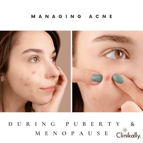 Managing acne during puberty and menopause