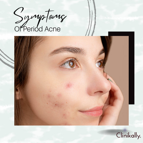 Symptoms of period acne