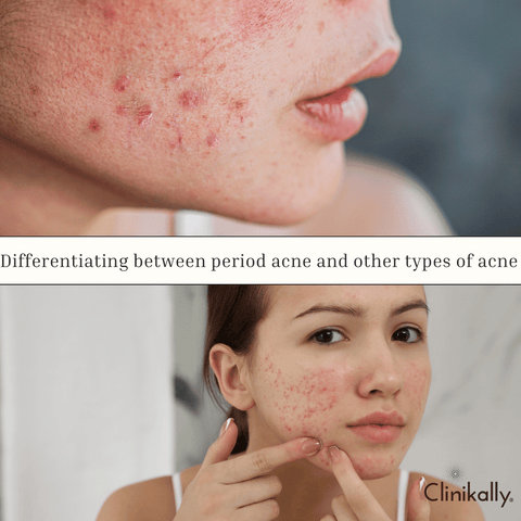 Differentiating between period acne and other types of acne