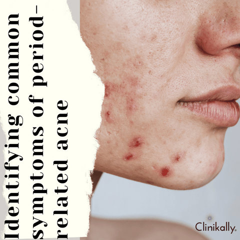 Identifying common symptoms of period-related acne