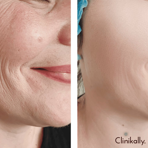 Hyaluronic Acid Serum for Wrinkles