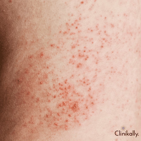 Dyshidrotic eczema