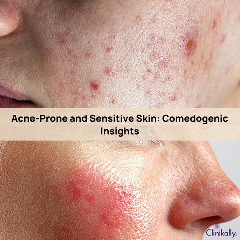 Acne-Prone and Sensitive Skin: Comedogenic Insights