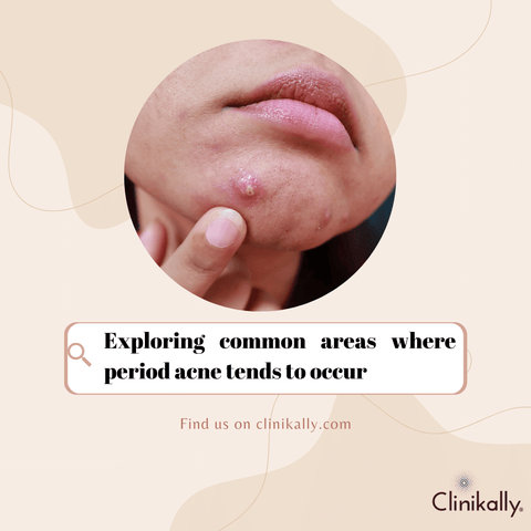 Exploring common areas where period acne tends to occur