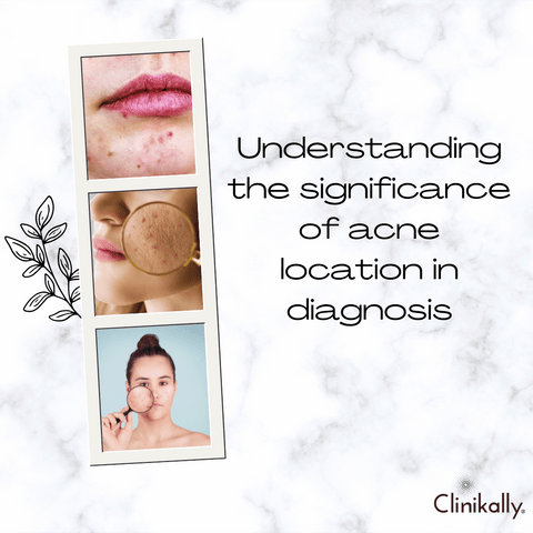 Understanding the significance of acne location in diagnosis