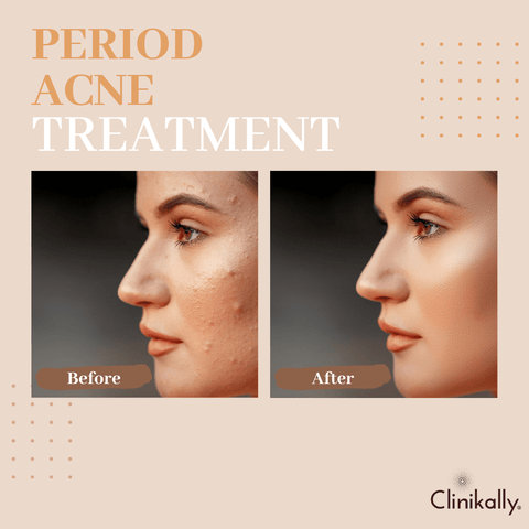 Period acne treatment
