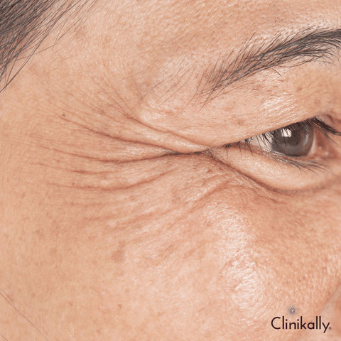 What causes wrinkles on the face?