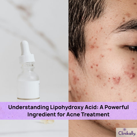 Impact of Lipohydroxy Acid for Acne Treatment
