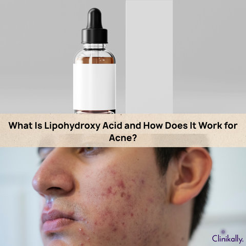 What Is Lipohydroxy Acid and How Does It Work for Acne?
