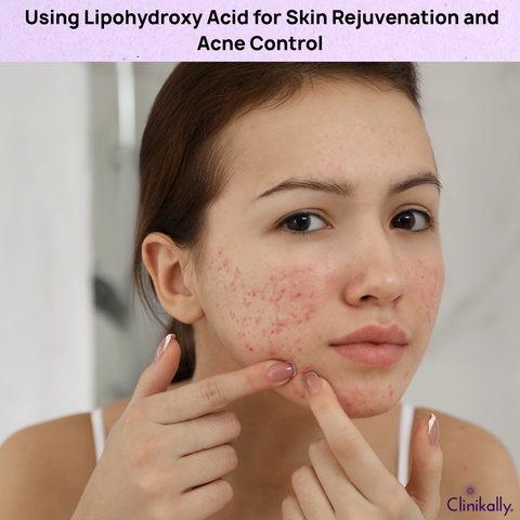 Using Lipohydroxy Acid for Skin Rejuvenation and Acne Control