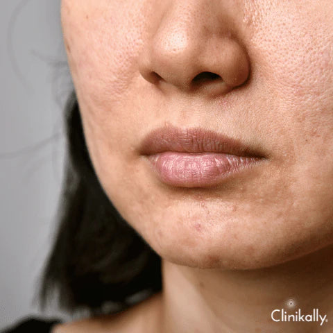 Helps prevent acne in future