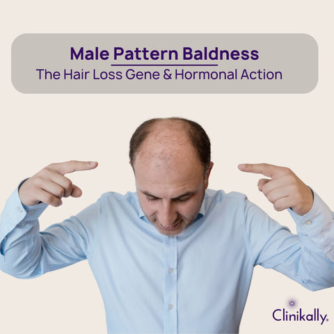 Understanding Male Pattern Baldness & Its Cause
