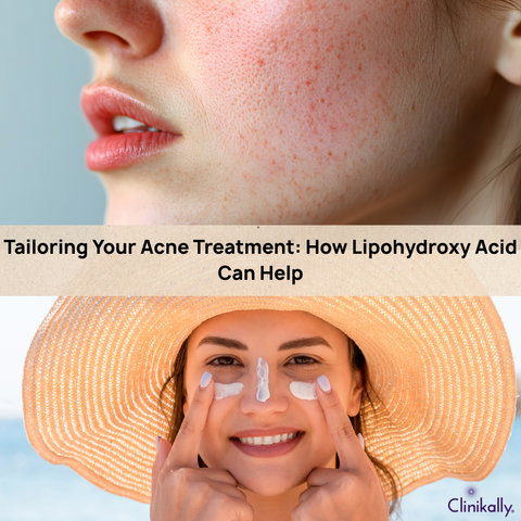 Tailoring Your Acne Treatment: How Lipohydroxy Acid Can Help