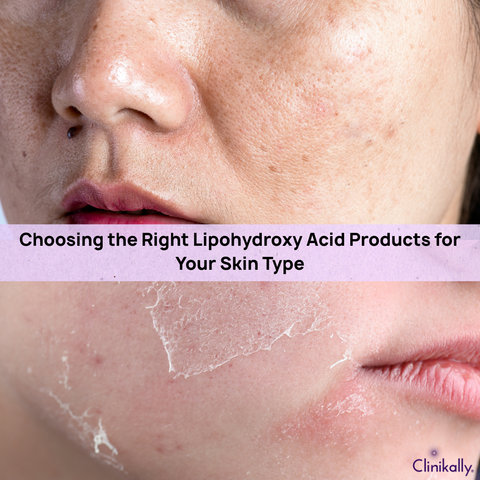 Choosing the Right Lipohydroxy Acid Products for Your Skin Type