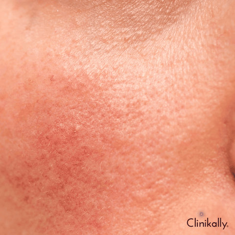 Preventing Skin Purging, Redness, and Burning When Using Glycolic Acid