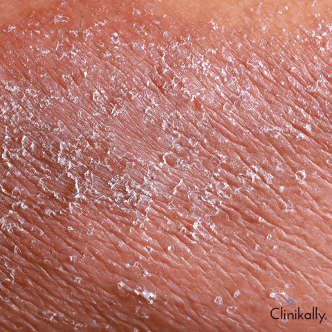 Nummular eczema
